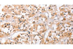 Immunohistochemistry of paraffin-embedded Human thyroid cancer using HDAC8 Polyclonal Antibody at dilution of 1:40 (HDAC8 抗体)