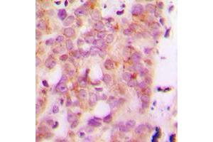 Immunohistochemical analysis of HLA-H staining in human breast cancer formalin fixed paraffin embedded tissue section. (HLA-H 抗体  (Center))