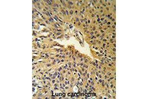 COG2 Antibody (N-term) IHC analysis in formalin fixed and paraffin embedded human Lung carcinoma followed by peroxidase conjugation of the secondary antibody and DAB staining. (COG2 抗体  (N-Term))