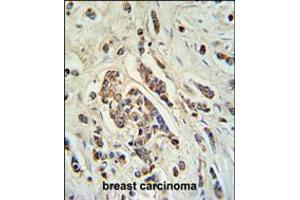 ABCC11 Antibody IHC analysis in formalin fixed and paraffin embedded breast carcinoma followed by peroxidase conjugation of the secondary antibody and DAB staining. (ABCC11 抗体  (N-Term))
