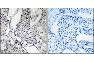 Immunohistochemistry analysis of paraffin-embedded human breast carcinoma tissue, using PHLDA3 Antibody. (PHLDA3 抗体  (AA 21-70))