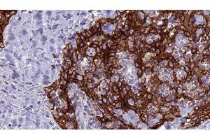 ABIN6279128 at 1/100 staining Human Head and neck cancer tissue by IHC-P. (SLC4A9 抗体)