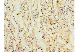 Immunohistochemistry of paraffin-embedded human lung cancer using ABIN7172386 at dilution of 1:100 (L3HYPDH 抗体  (AA 13-312))
