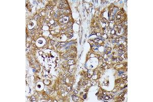 Immunohistochemistry of paraffin-embedded human colon carcinoma using MAK antibody (ABIN7268382) at dilution of 1:100 (40x lens). (MAK 抗体  (AA 370-435))