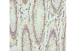 Immunohistochemistry of paraffin-embedded human colon cancer using ABIN7151997 at dilution of 1:100 (ERLIN2 抗体  (AA 212-339))