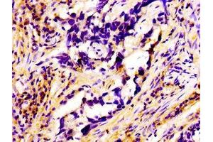 Immunohistochemistry of paraffin-embedded human pancreatic cancer using ABIN7167322 at dilution of 1:100 (RAB3A 抗体  (AA 1-220))