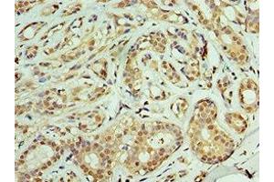 Immunohistochemistry of paraffin-embedded human breast cancer using ABIN7159904 at dilution of 1:100 (TIMM21 抗体  (AA 1-248))