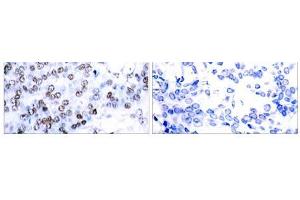 Immunohistochemical analysis of paraffin-embedded human breast carcinoma tissue using JunB (Ab-79) antibody(E021026). (JunB 抗体)