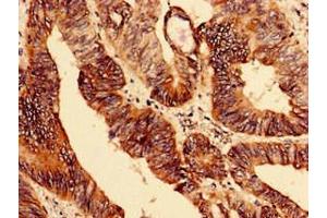Immunohistochemistry analysis of human colon cancer using ABIN7151479 at dilution of 1:100