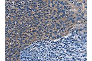 The image on the left is immunohistochemistry of paraffin-embedded Human cervical cancer tissue using ABIN7130029(KLRB1 Antibody) at dilution 1/40, on the right is treated with fusion protein. (CD161 抗体)