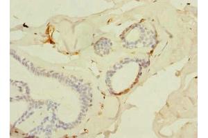 Immunohistochemistry of paraffin-embedded human breast cancer using ABIN7143534 at dilution of 1:100 (SLC25A4 抗体  (AA 40-74))