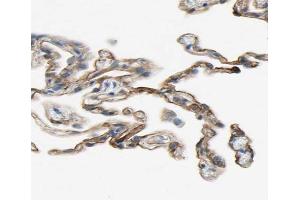 ABIN6266860 at 1/100 staining human lung carcinoma tissue sections by IHC-P. (Ephrin A5 抗体  (Internal Region))