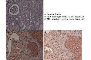 Immunohistochemistry with anti-ALG6 antibody showing ALG6 staining in the squamous epithelium of the uterine cervix as well as in inflammatory elements diffused in the stroma of human cervical cancer tissue at 20x and 40x (B & C).