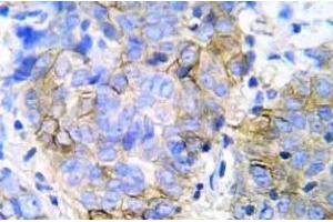 Immunohistochemistry (IHC) analyzes of JAK1 pAb in paraffin-embedded human lung adenocarcinoma tissue. (JAK1 抗体)
