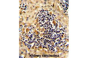 Formalin-fixed and paraffin-embedded human kidney carcionmareacted with ROR2 polyclonal antibody , which was peroxidase-conjugated to the secondary antibody, followed by AEC staining. (ROR2 抗体  (N-Term))