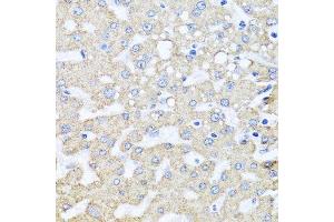 Immunohistochemistry of paraffin-embedded human liver injury using ARL6 antibody. (ARL6 抗体  (AA 1-186))