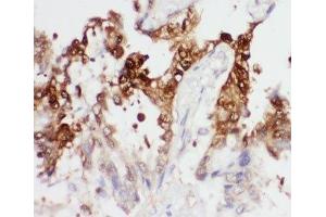 IHC-P: PGK1 antibody testing of human lung cancer tissue (PGK1 抗体  (Middle Region))