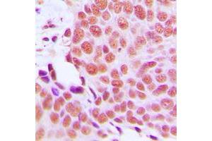 Immunohistochemical analysis of EMP staining in human breast cancer formalin fixed paraffin embedded tissue section. (MAEA 抗体  (Center))