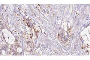 ABIN6273047 at 1/100 staining Human liver cancer tissue by IHC-P. (GSTA4 抗体  (N-Term))