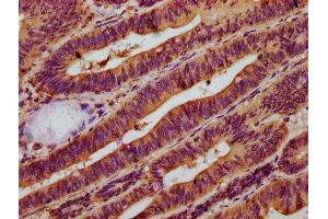 IHC image of ABIN7160684 diluted at 1:500 and staining in paraffin-embedded human colon cancer performed on a Leica BondTM system. (NAGPA 抗体  (AA 327-438))