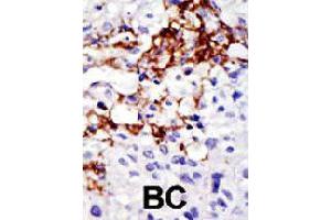 Formalin-fixed and paraffin-embedded human cancer tissue reacted with USP16 polyclonal antibody  , which was peroxidase-conjugated to the secondary antibody, followed by DAB staining . (USP16 抗体  (AA 132-160))