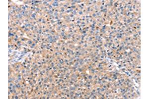 The image on the left is immunohistochemistry of paraffin-embedded Human breast cancer tissue using ABIN7128752(CAPN7 Antibody) at dilution 1/20, on the right is treated with fusion protein. (Calpain 7 抗体)