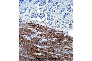 ACTA1 Antibody (ABIN1536597 and ABIN2843809) immunohistochemistry analysis in formalin fixed and paraffin embedded human colon carcinoma followed by peroxidase conjμgation of the secondary antibody and DAB staining. (Actin 抗体)