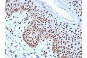Formalin-fixed, paraffin-embedded human Basal Cell Carcinoma stained with Histone H1 Mouse Recombinant Monoclonal Antibody (rAE-4). (Recombinant Histone H1 抗体)