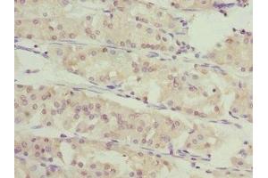 Immunohistochemistry of paraffin-embedded human gastric cancer using ABIN7166588 at dilution of 1:100 (SLC46A1 抗体  (AA 1-130))