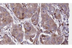 ABIN6276648 at 1/100 staining Human liver cancer tissue by IHC-P. (VAMP2 抗体  (N-Term))