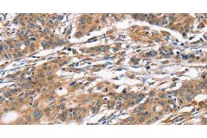 Immunohistochemistry of paraffin-embedded Human gasrtic cancer tissue using CAMK4 Polyclonal Antibody at dilution 1:40 (CAMK4 抗体)