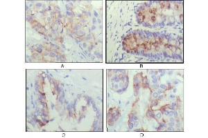 Immunohistochemical analysis of paraffin-embedded human lung cancer (A), recturn(B), prostate (C), colon cancer (D) showing cytoplasmic localization using IGFBP2 antibody with DAB staining. (IGFBP2 抗体  (AA 180-328))