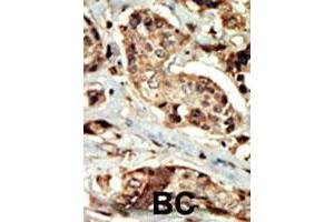 Formalin-fixed and paraffin-embedded human cancer tissue reacted with STK16 polyclonal antibody  , which was peroxidase-conjugated to the secondary antibody, followed by DAB staining. (STK16 抗体  (AA 257-286))