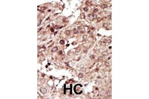 Formalin-fixed and paraffin-embedded human cancer tissue reacted with the primary antibody, which was peroxidase-conjugated to the secondary antibody, followed by AEC staining. (PHKG1 抗体  (AA 302-332))