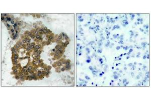 Immunohistochemical analysis of paraffin-embedded human lung carcinoma tissue using Akt2(Phospho-Ser474) Antibody(left) or the same antibody preincubated with blocking peptide(right).