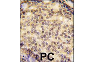 Formalin-fixed and paraffin-embedded human prostate carcinoma tissue reacted with SOX9 polyclonal antibody  , which was peroxidase-conjugated to the secondary antibody, followed by DAB staining. (SOX9 抗体  (N-Term))