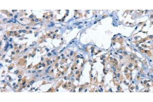 Immunohistochemistry of paraffin-embedded Human thyroid cancer tissue using PAK6 Polyclonal Antibody at dilution 1:40 (PAK6 抗体)