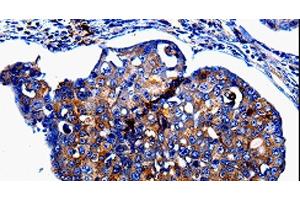Immunohistochemistry of paraffin-embedded Human breast cancer tissue using IL10RB Polyclonal Antibody at dilution 1:60 (IL10RB 抗体)