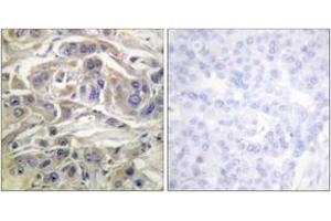 Immunohistochemistry analysis of paraffin-embedded human breast carcinoma, using RapGEF1 (Ab-504) Antibody. (GRF2 抗体  (AA 470-519))