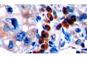 Detection of CTLA4 in Human Lymphoma Tissue using Polyclonal Antibody to Cytotoxic T-Lymphocyte Associated Antigen 4 (CTLA4) (CTLA4 抗体  (AA 52-211))