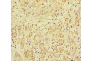 Immunohistochemistry of paraffin-embedded human pancreatic cancer using ABIN7176219 at dilution of 1:100 (ZNF287 抗体  (AA 130-364))