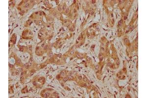 IHC image of ABIN7155266 diluted at 1:300 and staining in paraffin-embedded human melanoma cancer performed on a Leica BondTM system. (KAT2A 抗体  (AA 302-537))