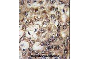 Formalin-fixed and paraffin-embedded human hepatocarcinoma tissue reacted with HIPK2 Antibody (Center) (ABIN391777 and ABIN2841636) , which was peroxidase-conjugated to the secondary antibody, followed by DAB staining. (HIPK2 抗体  (AA 437-468))