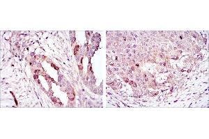 Immunohistochemical analysis of paraffin-embedded ovarian cancer (left) and lung cancer (right) using AURKA mouse mAb with DAB staining. (Aurora A 抗体)