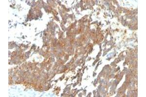 Immunohistochemical staining (Formalin-fixed paraffin-embedded sections) of human ovarian carcinoma with GNRHR/LHCGR monoclonal antibody, clone GNRHR/768 . (GNRHR 抗体)