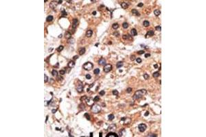 Formalin-fixed and paraffin-embedded human cancer tissue reacted with the primary antibody, which was peroxidase-conjugated to the secondary antibody, followed by AEC staining. (AF9 抗体  (C-Term))