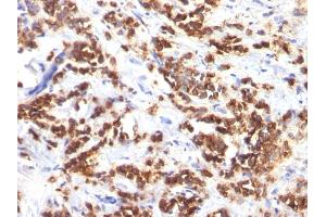 Formalin-fixed, paraffin-embedded human Breast Carcinoma stained with Milk Fat Globule Monoclonal Antibody (MFG-06) (MFGE8 抗体)