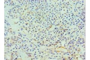 Immunohistochemistry of paraffin-embedded human breast cancer using ABIN7150176 at dilution of 1:100