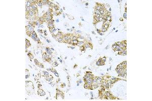 Immunohistochemistry of paraffin-embedded human gastric cancer using ALKBH8 antibody at dilution of 1:100 (x40 lens). (ALKBH8 抗体)