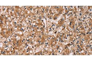Immunohistochemistry of paraffin-embedded Human prostate cancer using HTR3C Polyclonal Antibody at dilution of 1:30 (HTR3C 抗体)